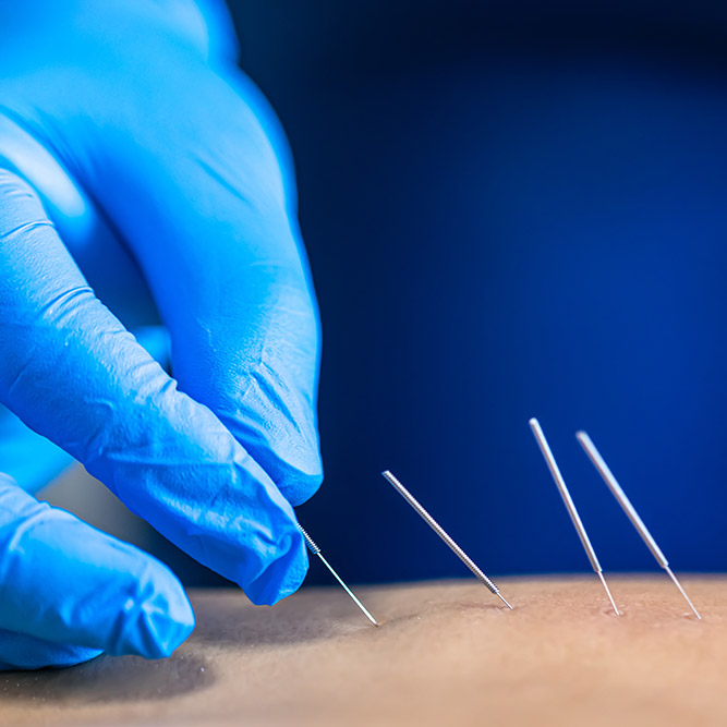 Close up of a needle and hands doing a dry needling.