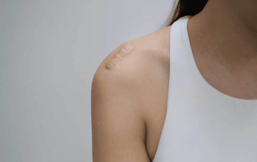 A shoulder with a visible surgical scar, highlighting tissue restrictions and healing challenges that dynamic cupping can help improve through decompression and improved mobility.