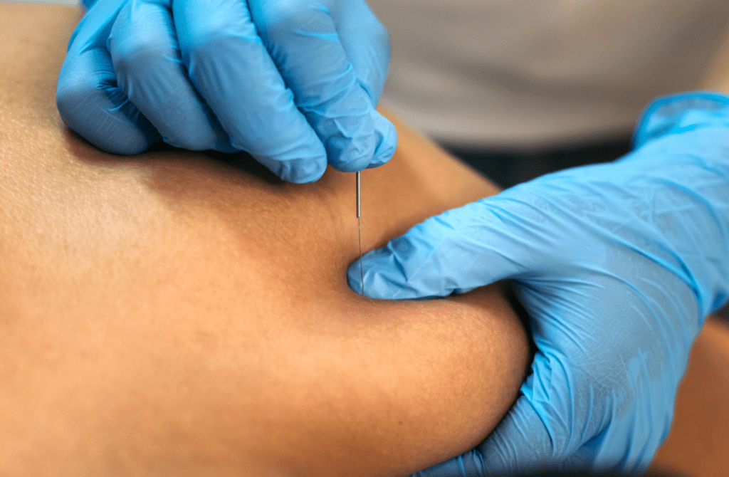 Dry needling technique applied to muscle tissue for pain relief and improved mobility.