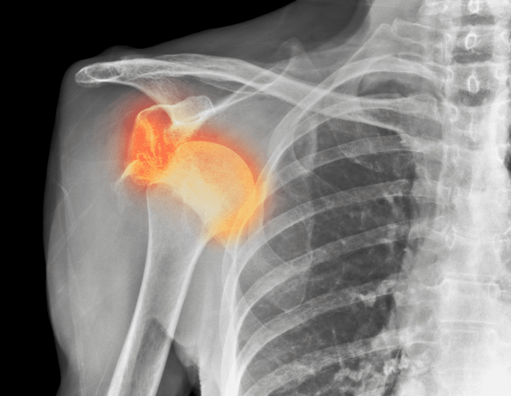 Shoulder X-ray image highlighting joint structures, showing that imaging alone cannot diagnose shoulder impingement or explain movement-related pain.