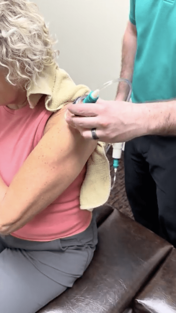 Clinician performing dynamic cupping for shoulder impingement to improve tissue glide and reduce shoulder compression.