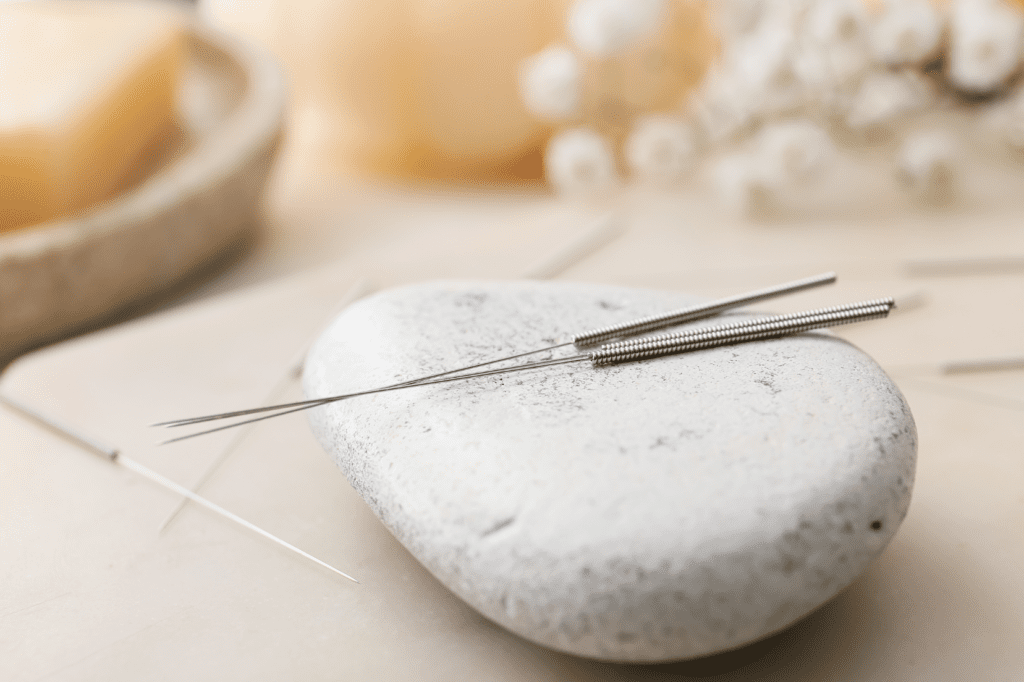 Dry needling needles used for treating headaches and TMJ trigger points, a therapy that helps release muscle tension and reduce chronic head and jaw pain.