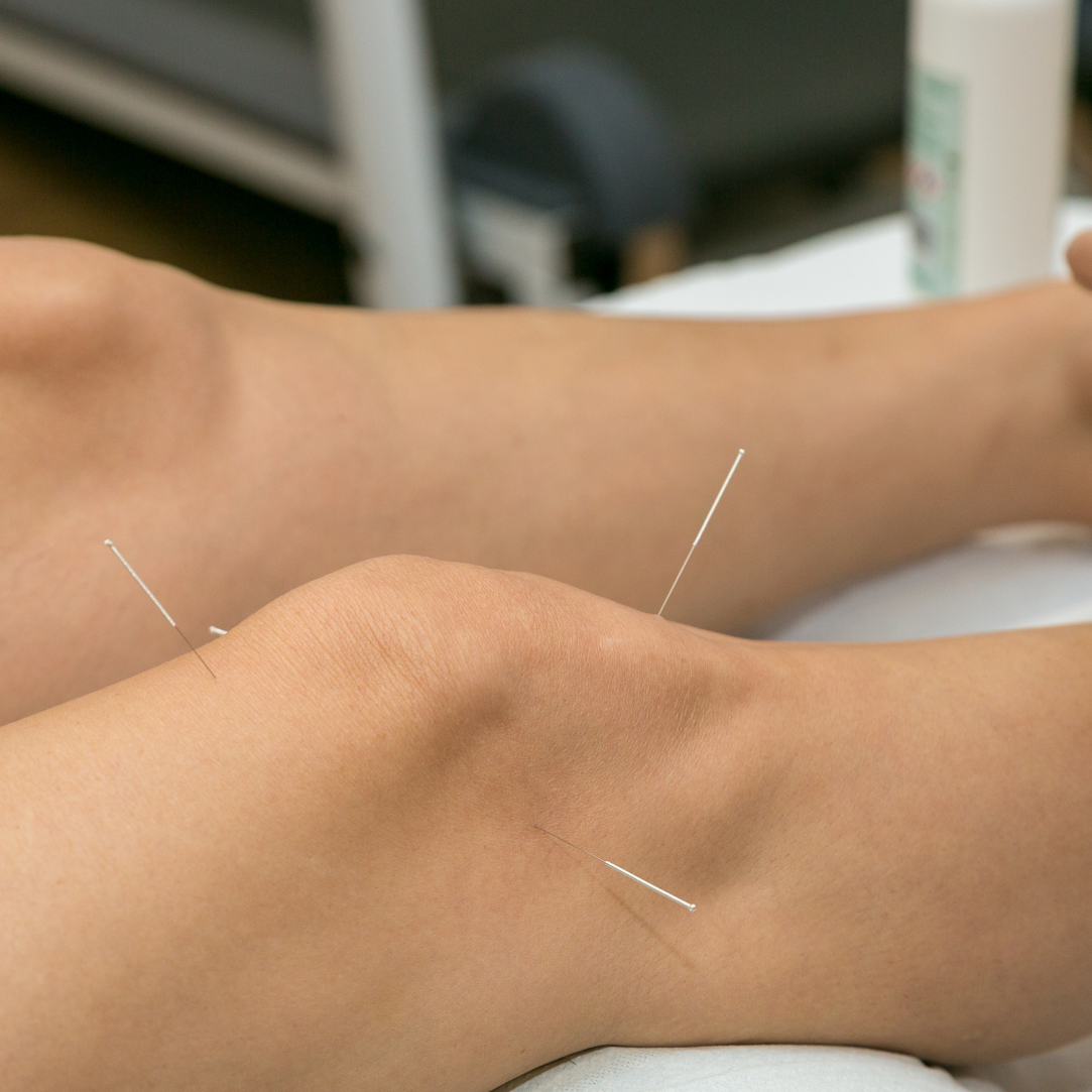 Dry needling treatment applied to the knee to help relieve pain from sports injuries.
